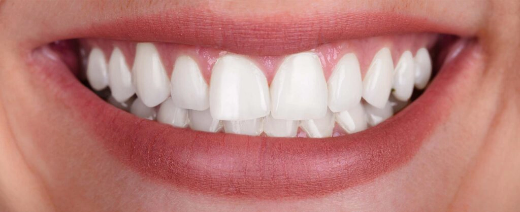 White teeth after cosmetic dental exam
