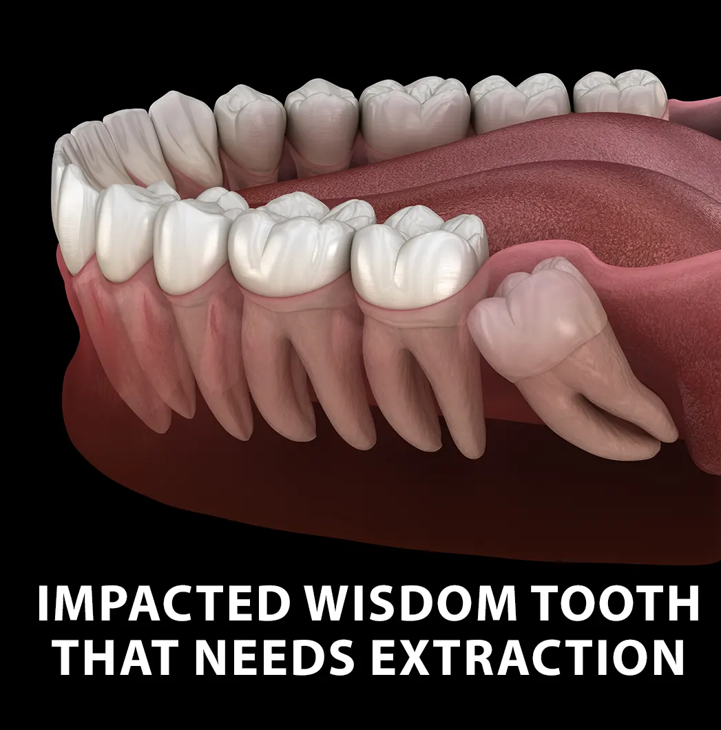 Image showing an impacted tooth in the jaw that needs to be extracted